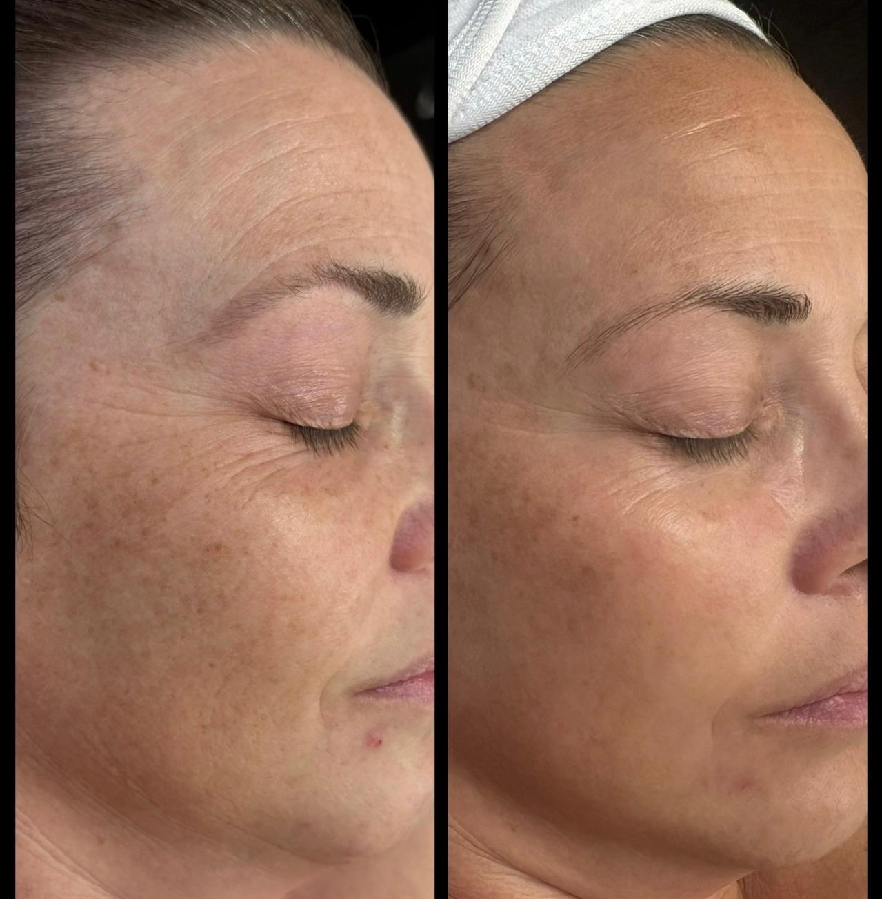 MicroPeel + Customized Skincare