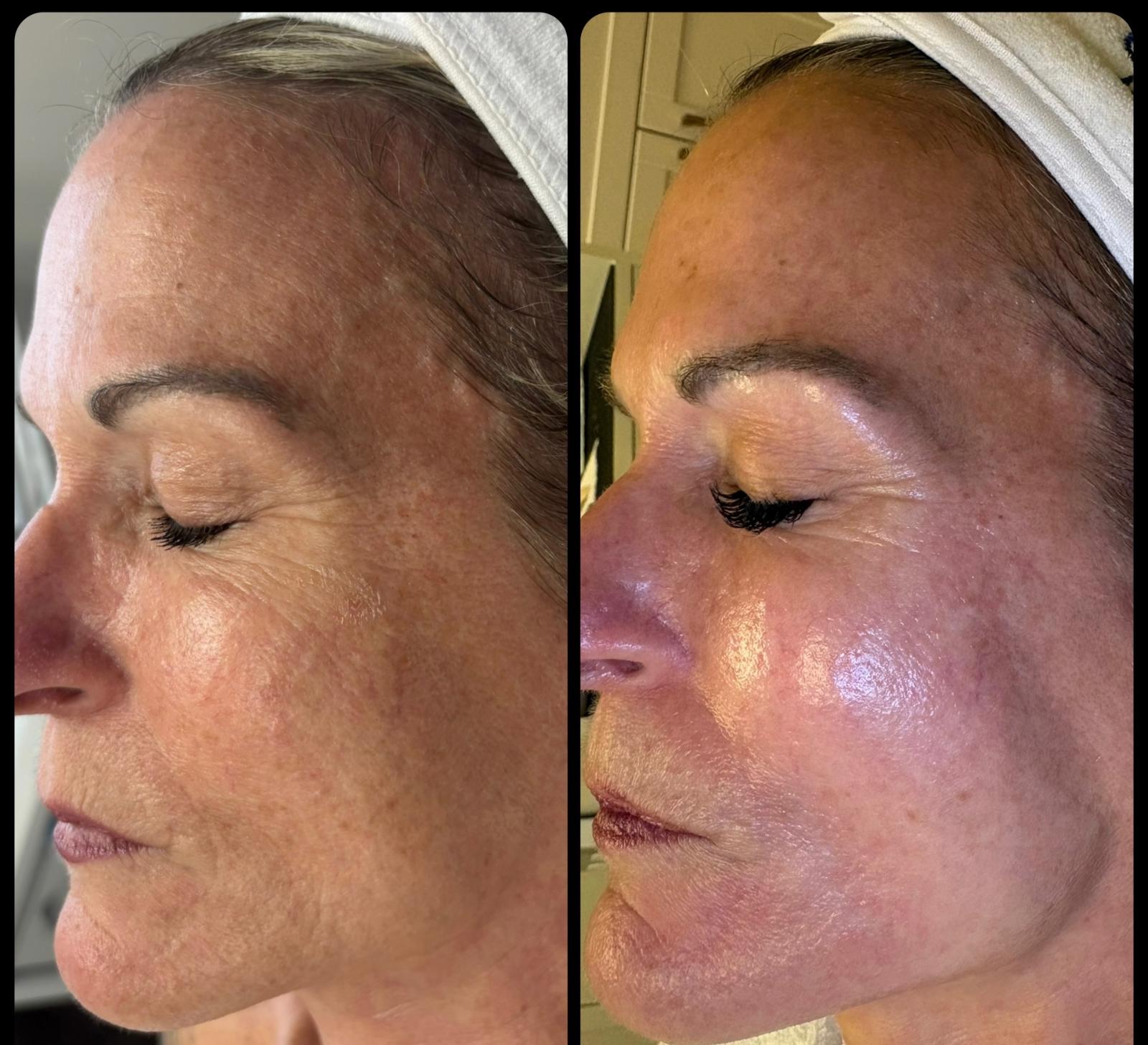 ProCell + MicroPeel Series